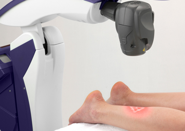 لیزر درمانی پشت پا با دستگاه m6