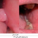 درمان پاپیلوم دهانی با لیزر co2