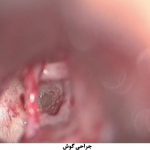 جراحی گوش با لیزر