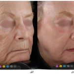 درمان چین و چروک صورت با لیزر