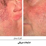 درمان ضایعات عروقی با لیزر