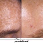 درمان تغییر رنگدانه پوستی با لیزر اندیاگ