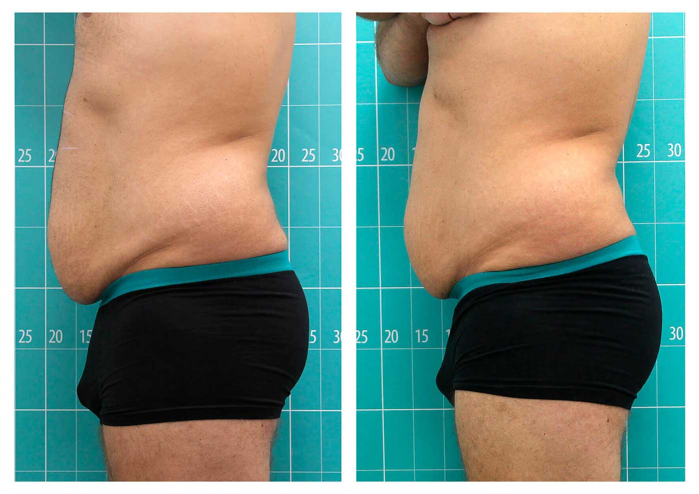 آب کردن چربی شکم بعد 3 جلسه criocuum