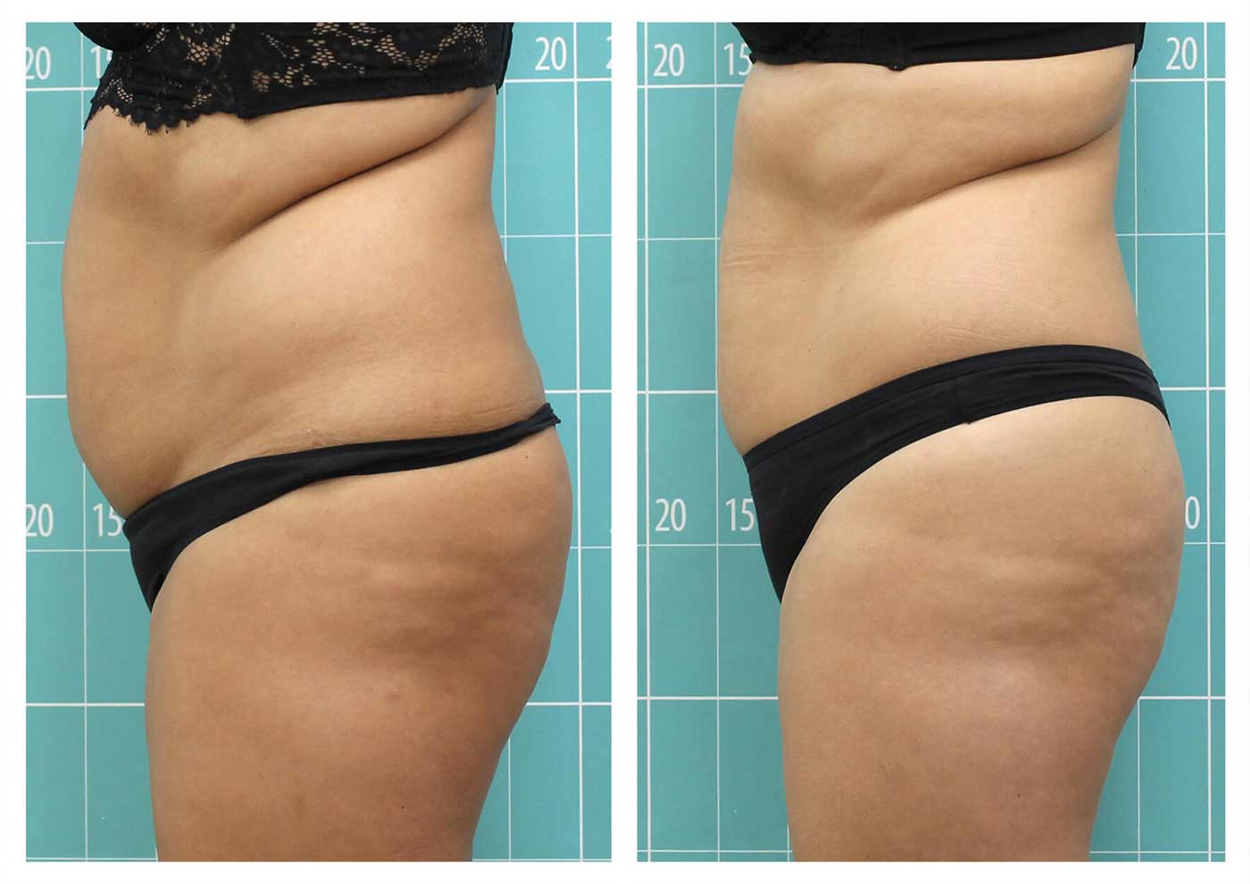 آب کردن چربی شکم با 3 جلسه دستگاه لاغری کریوم