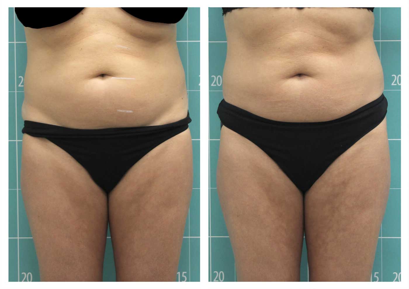 آب کردن چربی شکم با 3 جلسه دستگاه لاغری کریوم