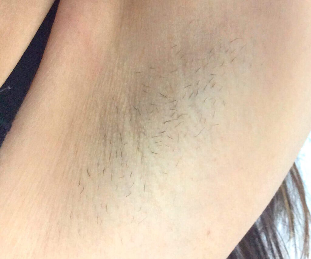 Photo of armpit hair before laser