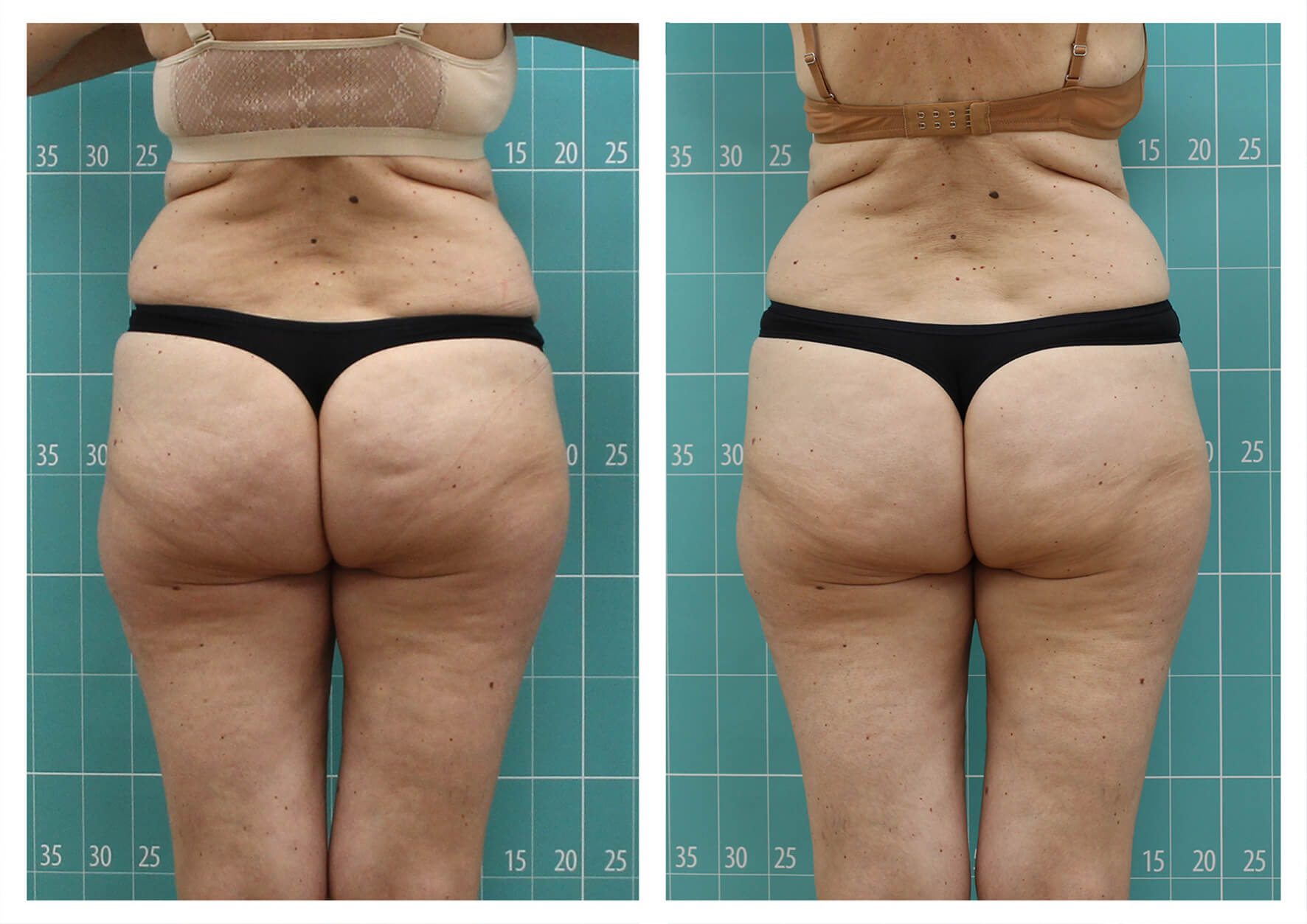 Before and after weight loss with zionic device