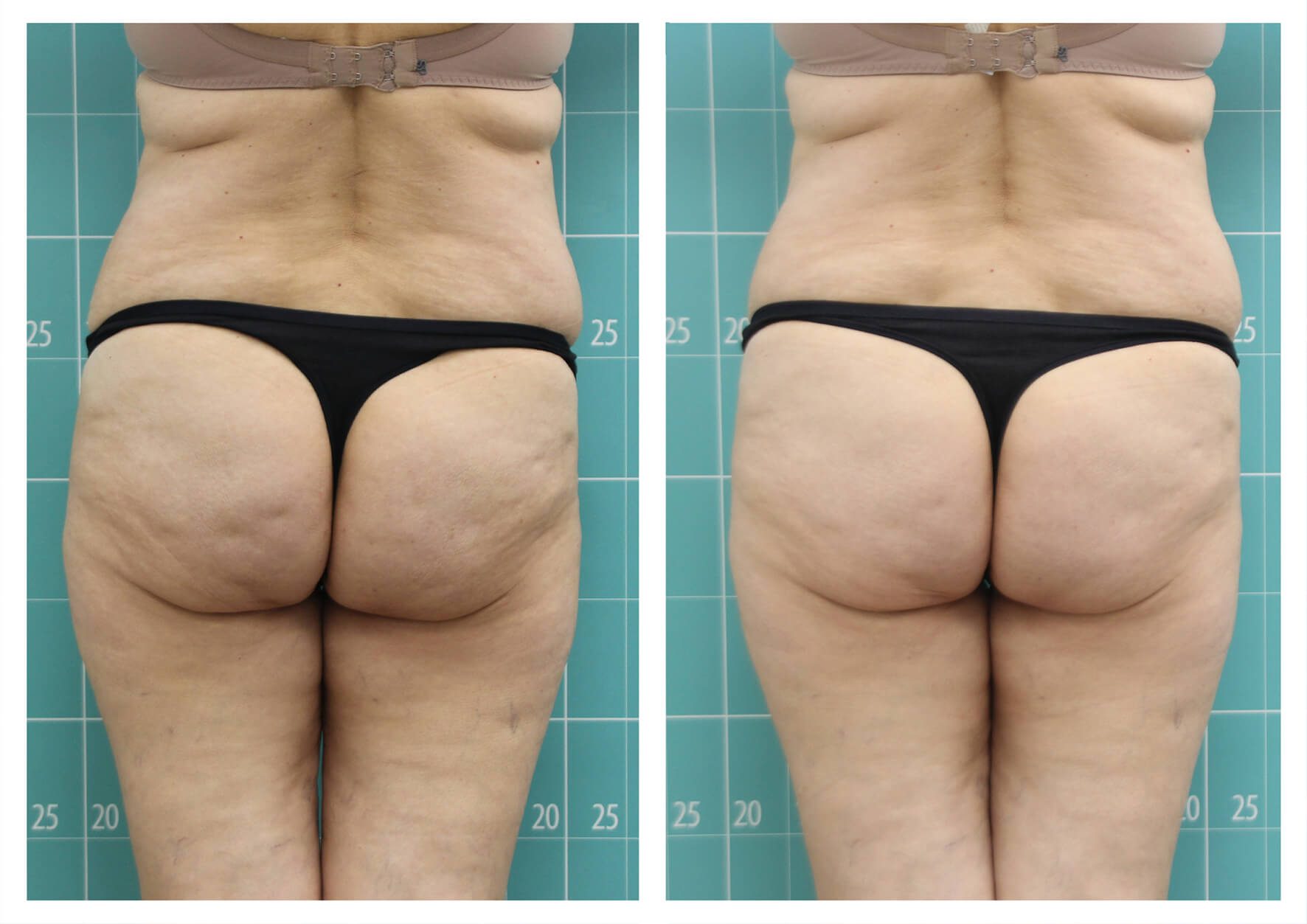 Photo before and after skin tightening with zionic device