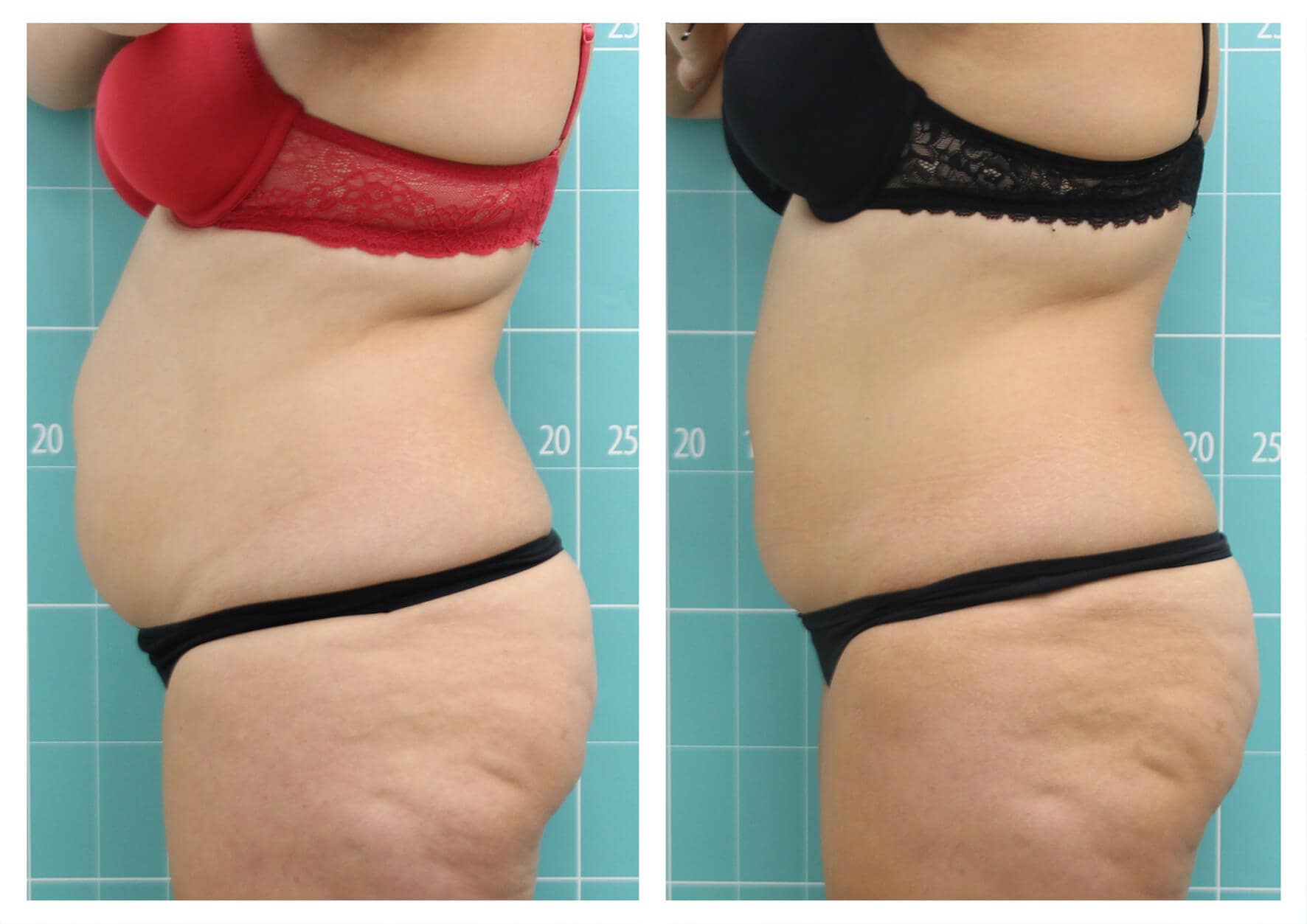 Photo before and after rejuvenation with zionic device