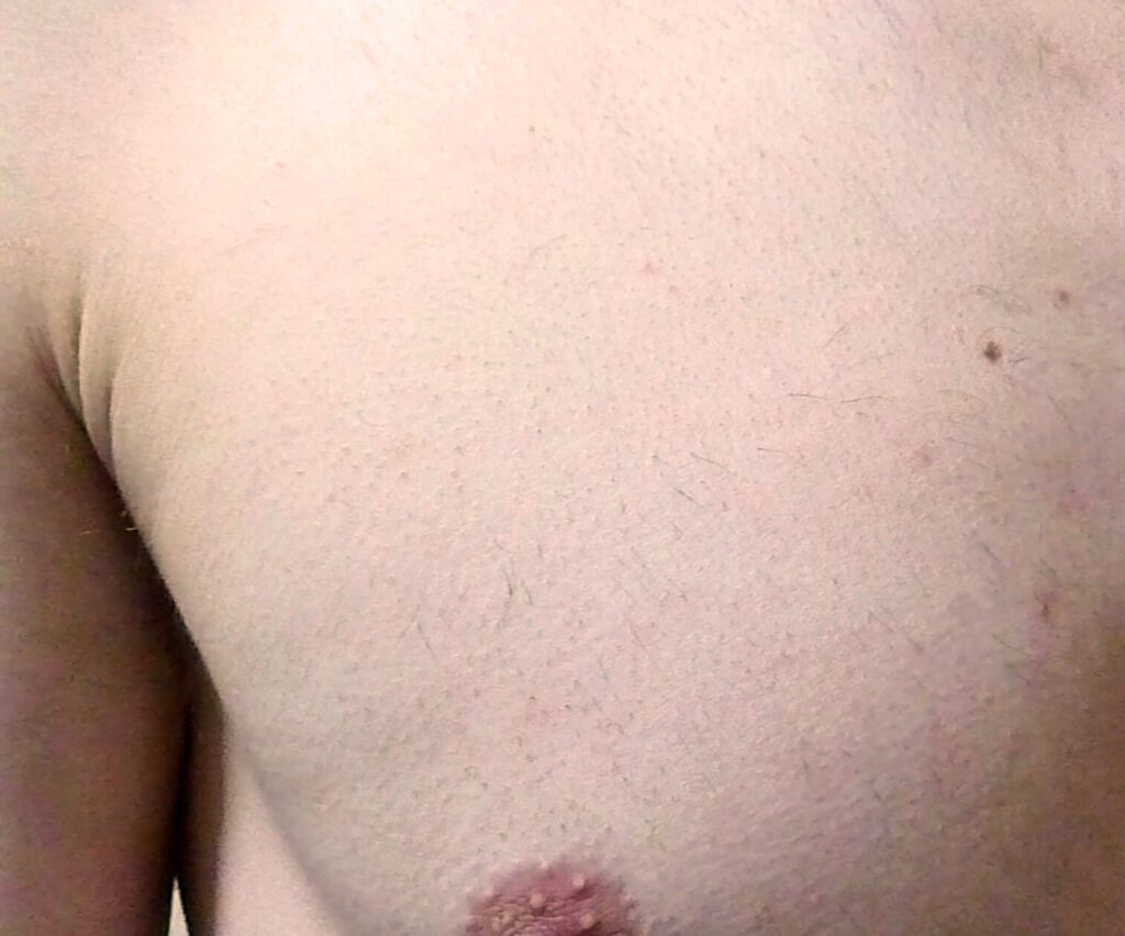 Photo of men's chest hair after diode laser hair removal