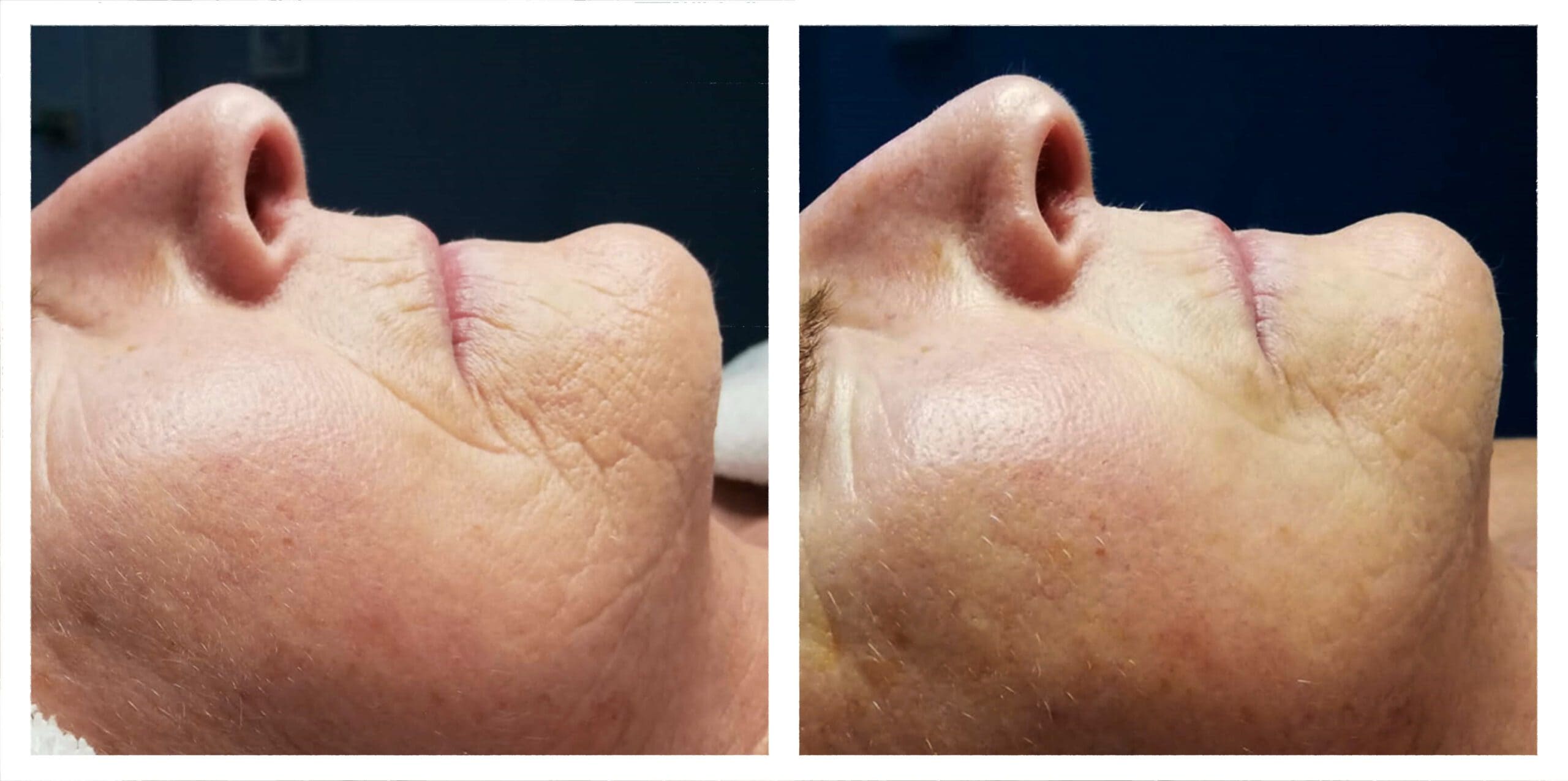 عکس قبل و بعد جوانسازی پوست با دستگاه ترموسلود