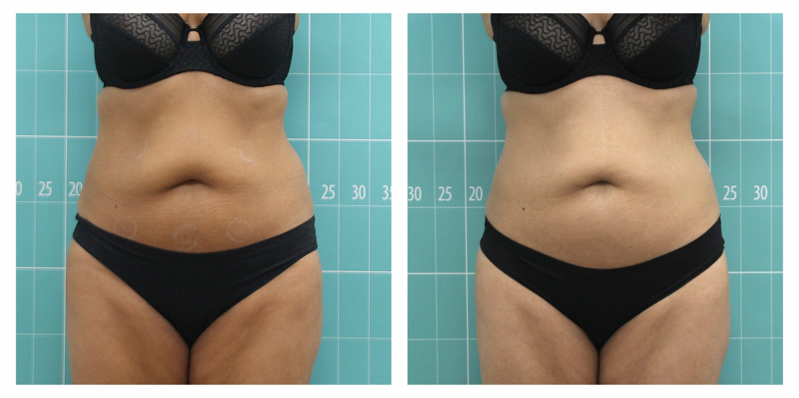 عکس قبل و بعد سفت کردن پوست با دستگاه symmed