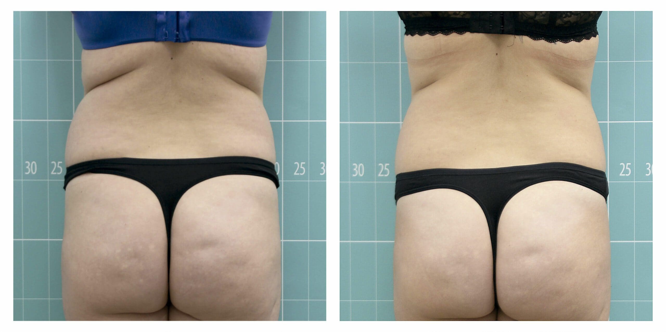 عکس قبل و بعد کاهش سایز با دستگاه اسپانیایی symmed