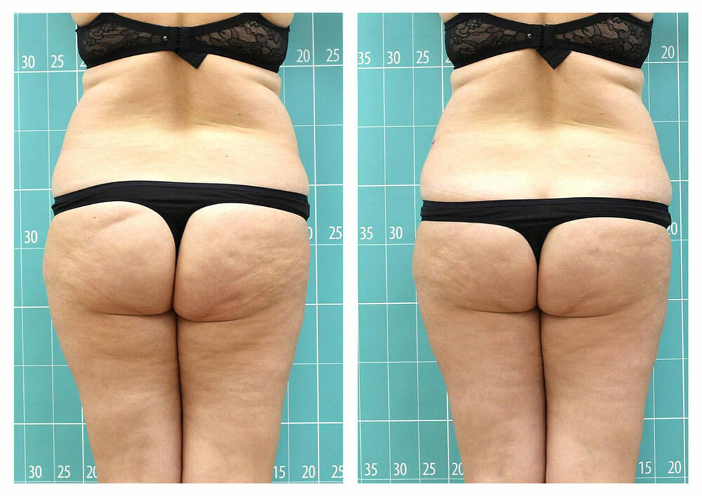 رفع سلولیت باسن با دستگاه