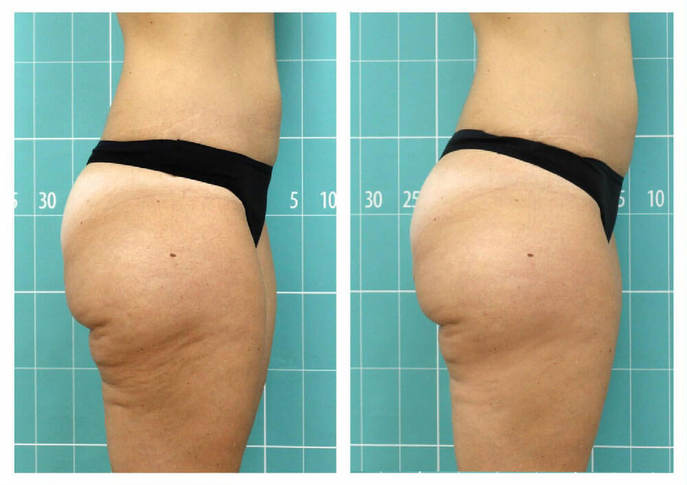 رفع سلولیت ران با دستگاه