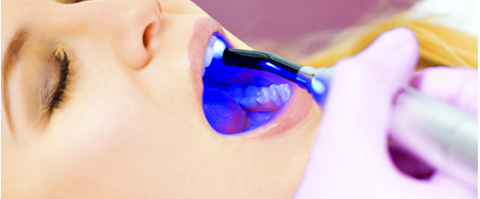 درمان پوسیدگی و خرابی دندان با لیزر