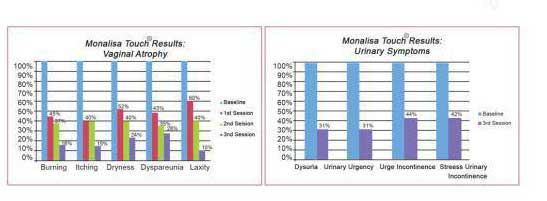 کاهش علائم ناشی از آتروفی واژن و تکرر ادرار طی درمان با لیزر مونالیزا
